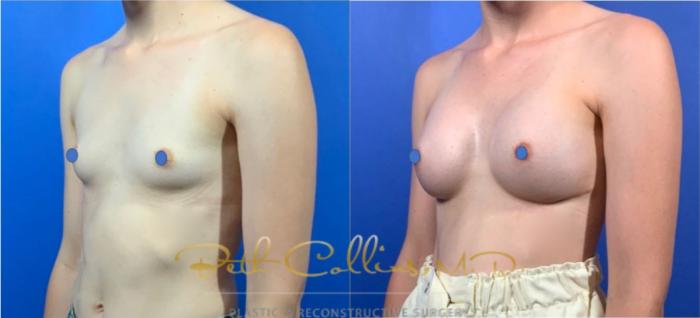 Before & After Breast Augmentation Case 125 View #2 View in Guilford, CT