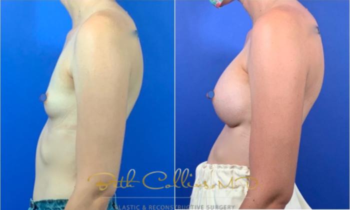 Before & After Breast Augmentation Case 125 View #3 View in Guilford, CT