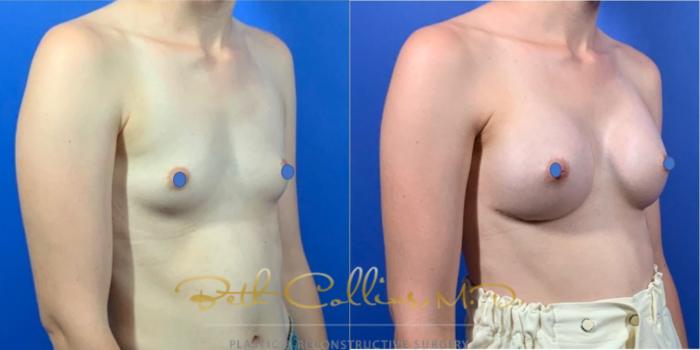 Before & After Breast Augmentation Case 125 View #4 View in Guilford, CT