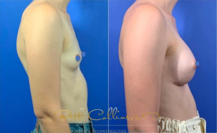 Before & After Breast Augmentation Case 125 View #5 View in Guilford, CT