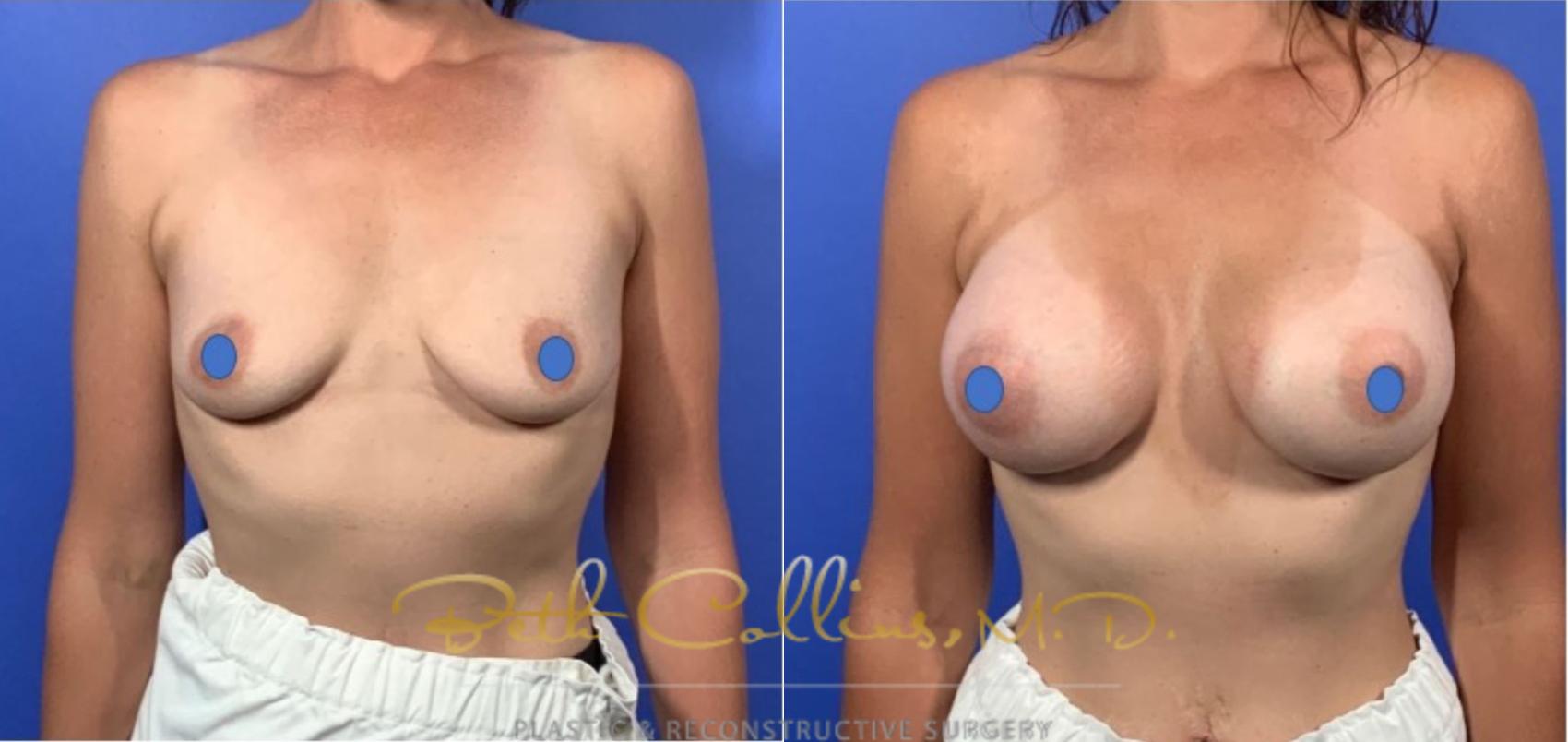 Before & After Breast Augmentation Case 127 View #1 View in Guilford, CT