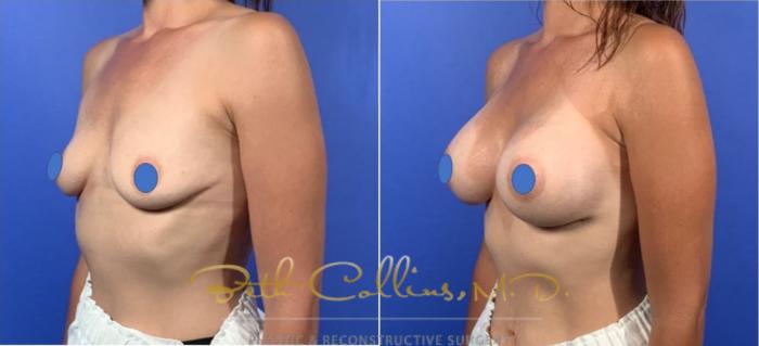Before & After Breast Augmentation Case 127 View #2 View in Guilford, CT
