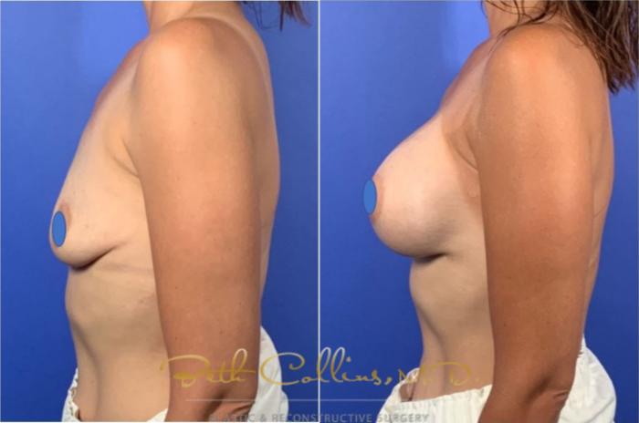 Before & After Breast Augmentation Case 127 View #3 View in Guilford, CT