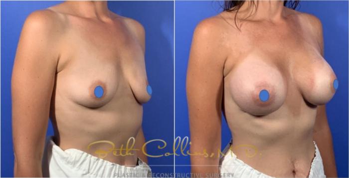 Before & After Breast Augmentation Case 127 View #4 View in Guilford, CT