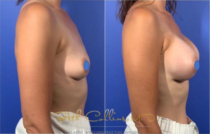 Before & After Breast Augmentation Case 127 View #5 View in Guilford, CT