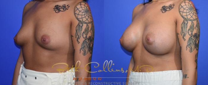 Before & After Breast Augmentation Case 129 Left Oblique View in Guilford, CT
