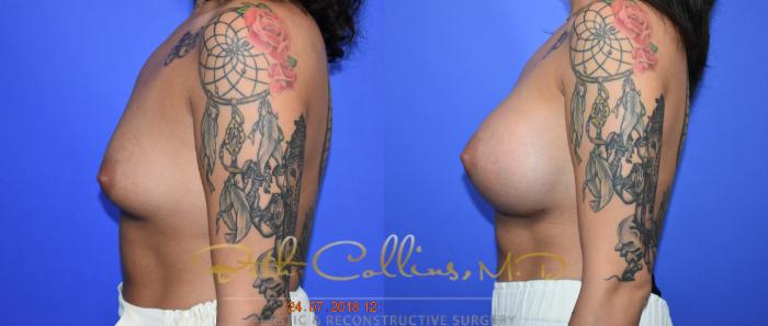 Before & After Breast Augmentation Case 129 Left Side View in Guilford, CT