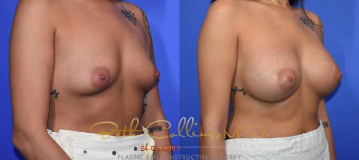 Before & After Breast Augmentation Case 129 Right Oblique View in Guilford, CT