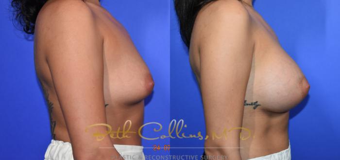 Before & After Breast Augmentation Case 129 Right Side View in Guilford, CT