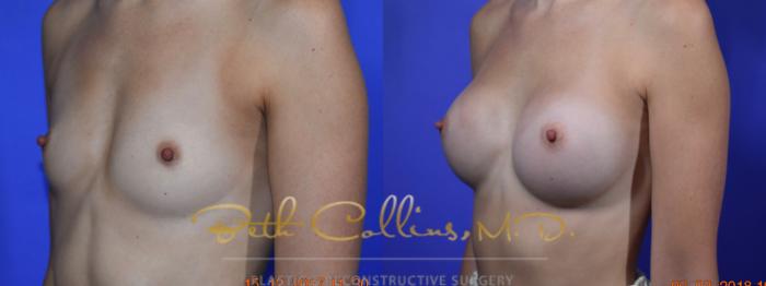 Before & After Breast Augmentation Case 130 Left Oblique View in Guilford, CT
