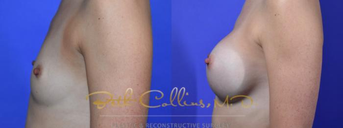 Before & After Breast Augmentation Case 130 Left Side View in Guilford, CT
