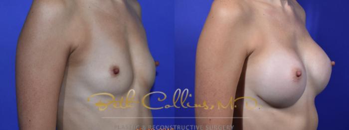 Before & After Breast Augmentation Case 130 Right Oblique View in Guilford, CT
