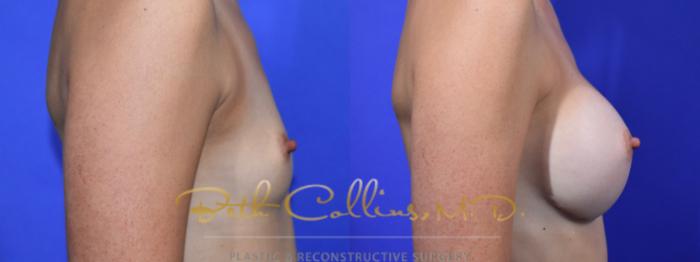 Before & After Breast Augmentation Case 130 Right Side View in Guilford, CT