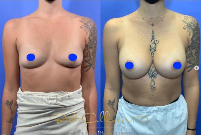 Before & After Breast Augmentation Case 258 Front View in Guilford, CT