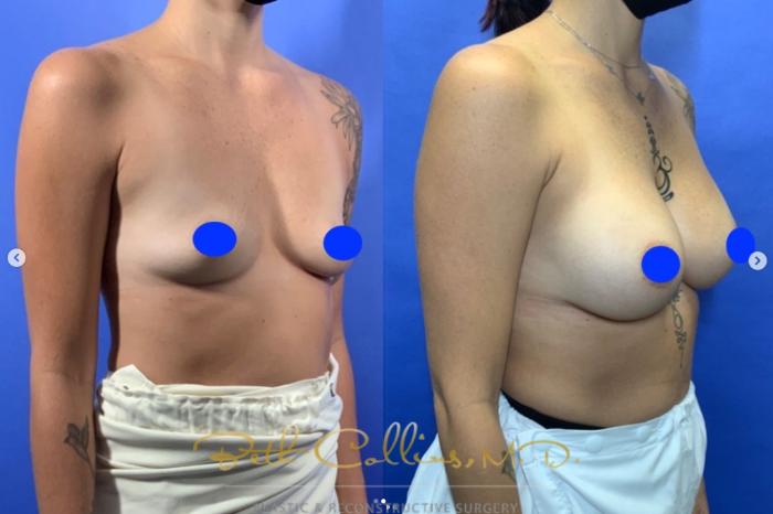 Before & After Breast Augmentation Case 258 Right Oblique View in Guilford, CT