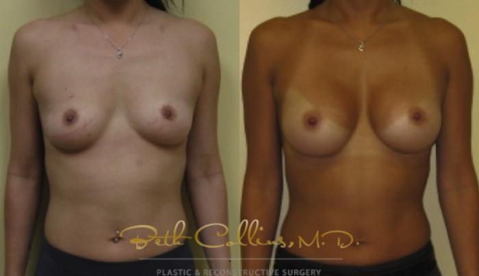 Before & After Breast Augmentation Case 26 View #1 View in Guilford, CT
