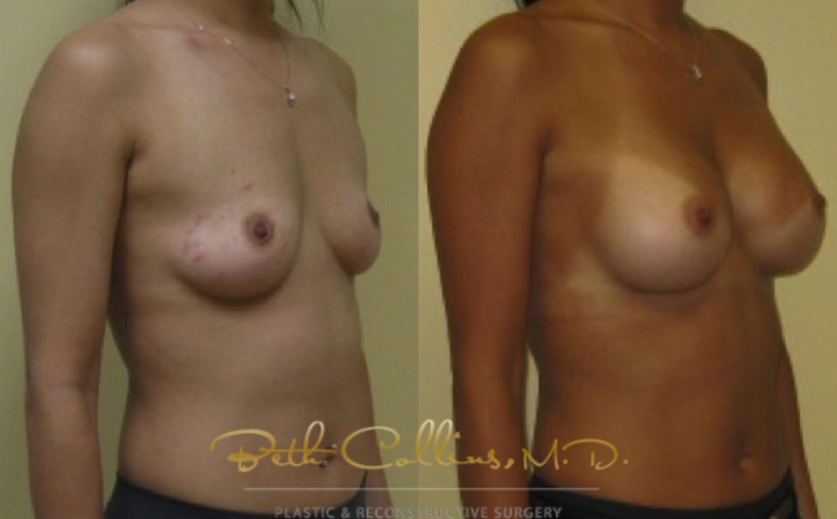 Before & After Breast Augmentation Case 26 View #2 View in Guilford, CT