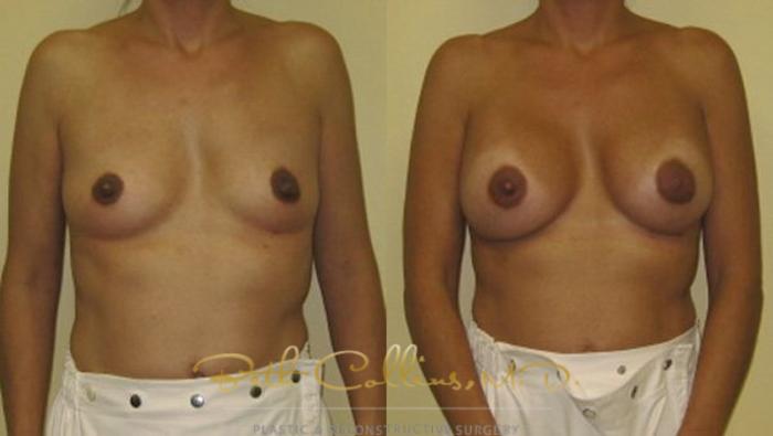 Before & After Breast Augmentation Case 27 View #1 View in Guilford, CT