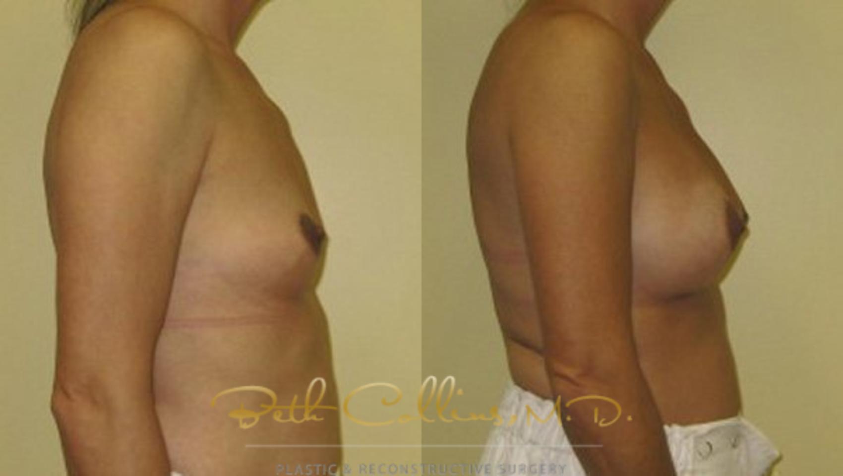 Before & After Breast Augmentation Case 27 View #2 View in Guilford, CT