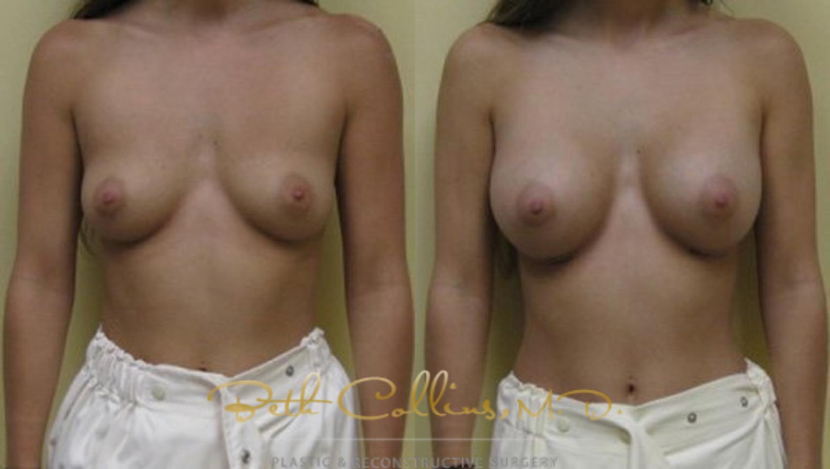 Before & After Breast Augmentation Case 28 View #1 View in Guilford, CT