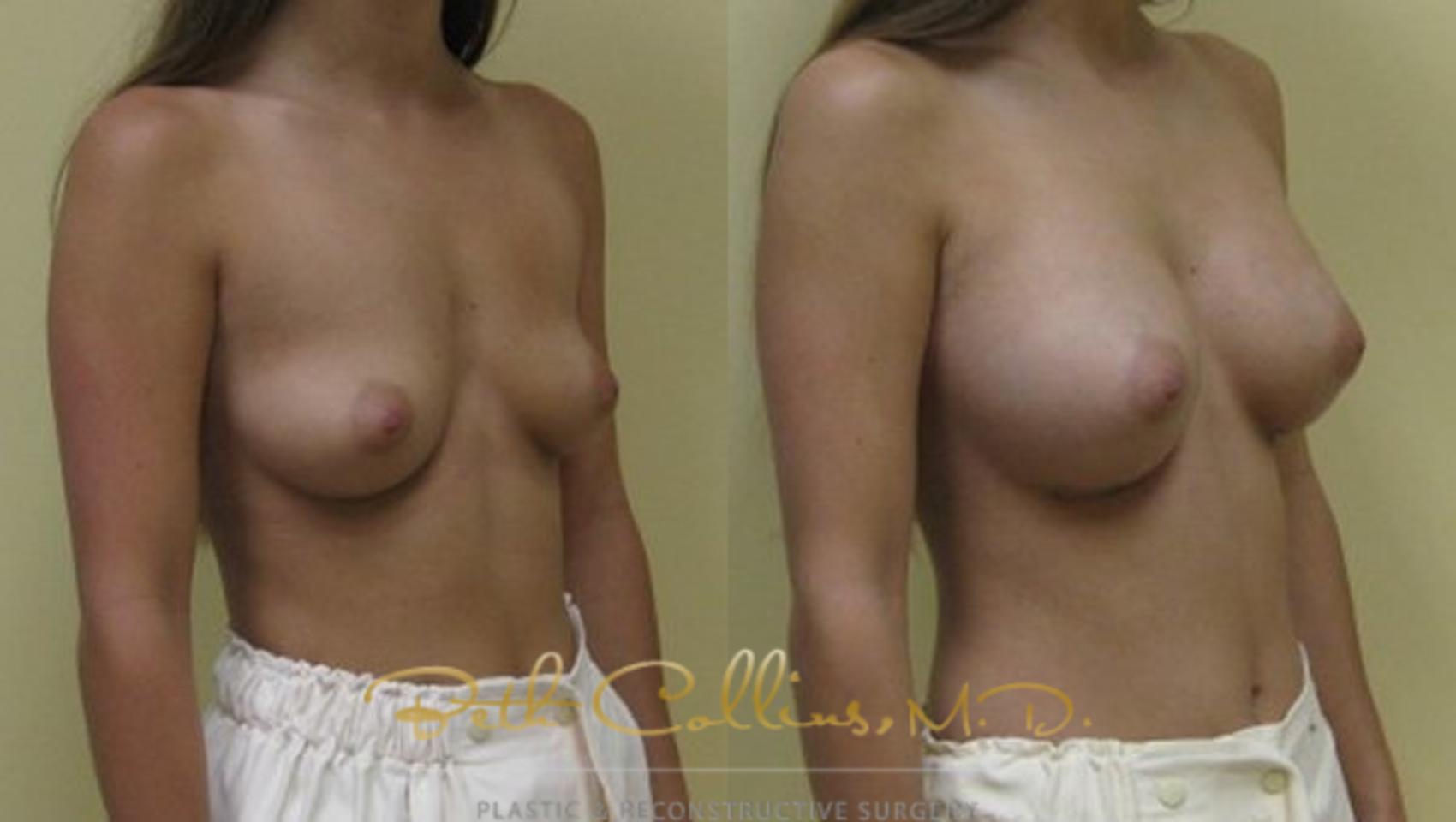 Before & After Breast Augmentation Case 28 View #2 View in Guilford, CT