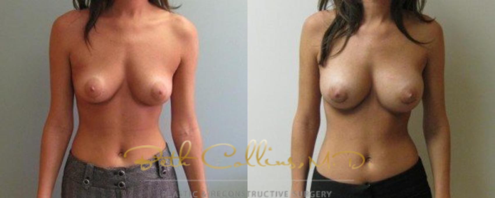Before & After Breast Augmentation Case 29 View #1 View in Guilford, CT