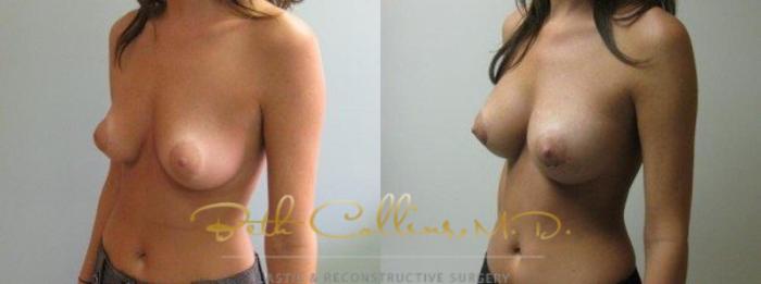 Before & After Breast Augmentation Case 29 View #2 View in Guilford, CT