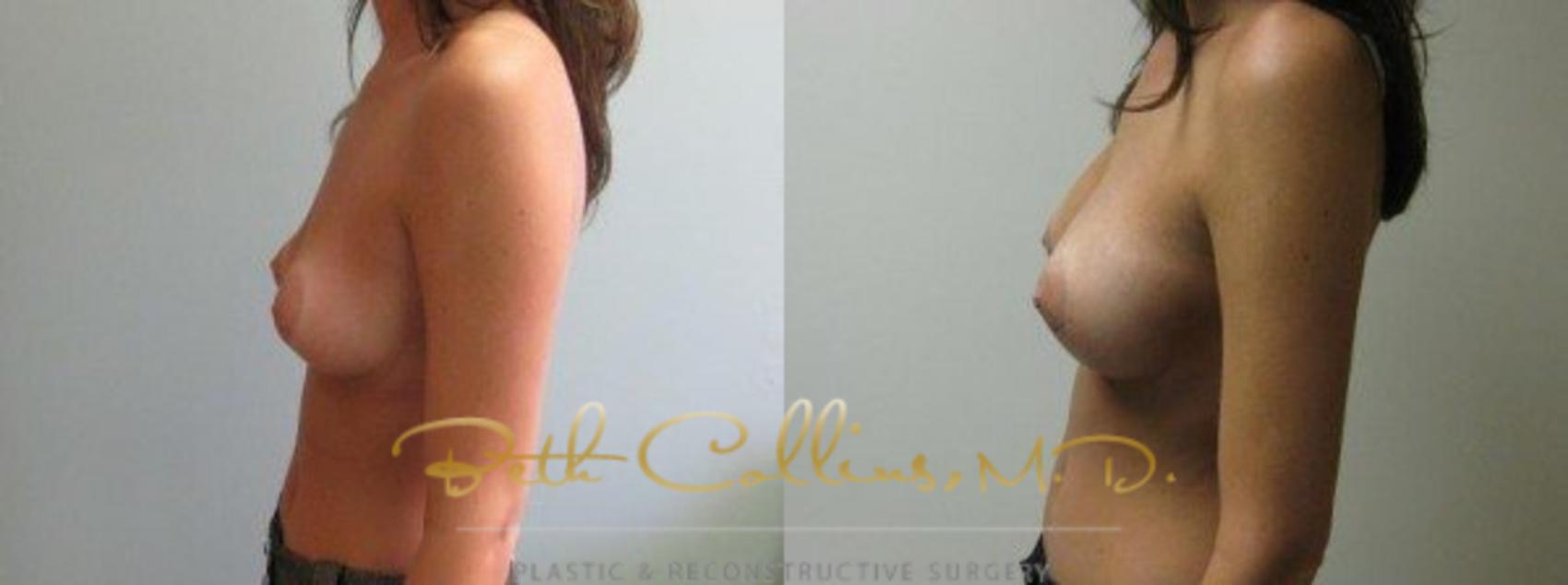 Before & After Breast Augmentation Case 29 View #3 View in Guilford, CT