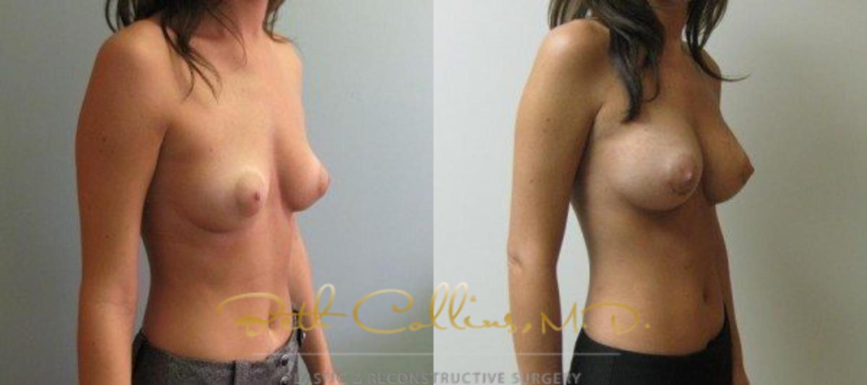 Before & After Breast Augmentation Case 29 View #4 View in Guilford, CT