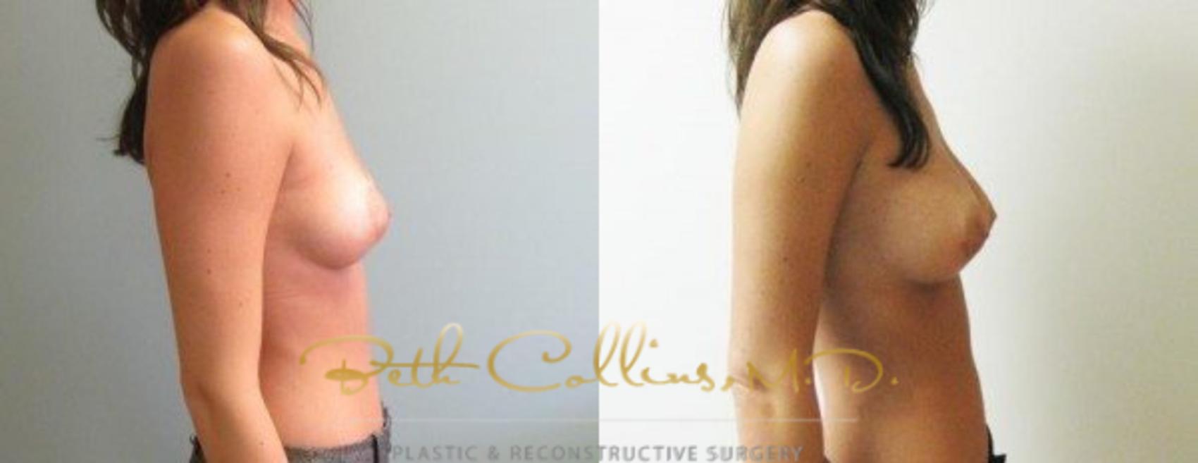 Before & After Breast Augmentation Case 29 View #5 View in Guilford, CT