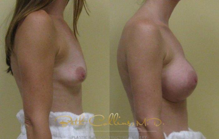 Before & After Breast Augmentation Case 30 View #2 View in Guilford, CT