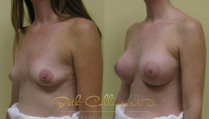 Before & After Breast Augmentation Case 30 View #5 View in Guilford, CT