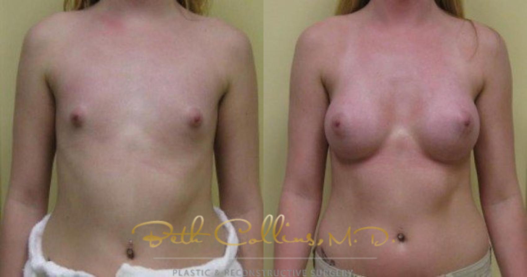 Before & After Breast Augmentation Case 31 View #1 View in Guilford, CT