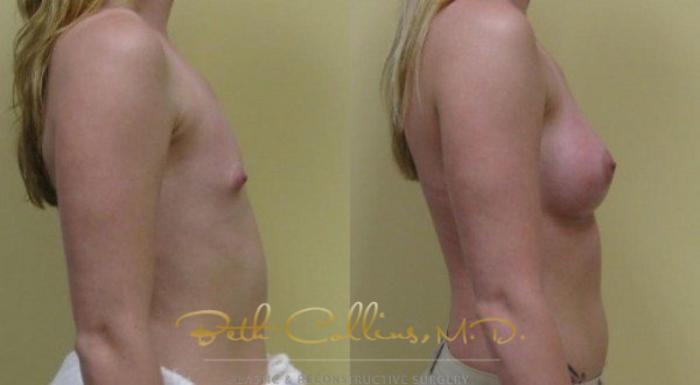 Before & After Breast Augmentation Case 31 View #2 View in Guilford, CT