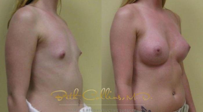 Before & After Breast Augmentation Case 31 View #3 View in Guilford, CT