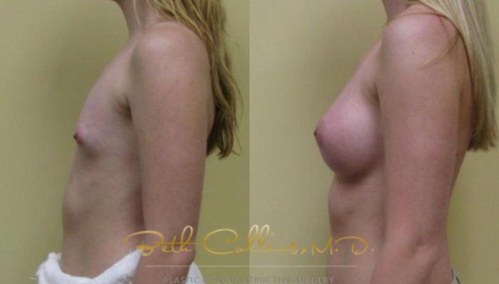 Before & After Breast Augmentation Case 31 View #4 View in Guilford, CT