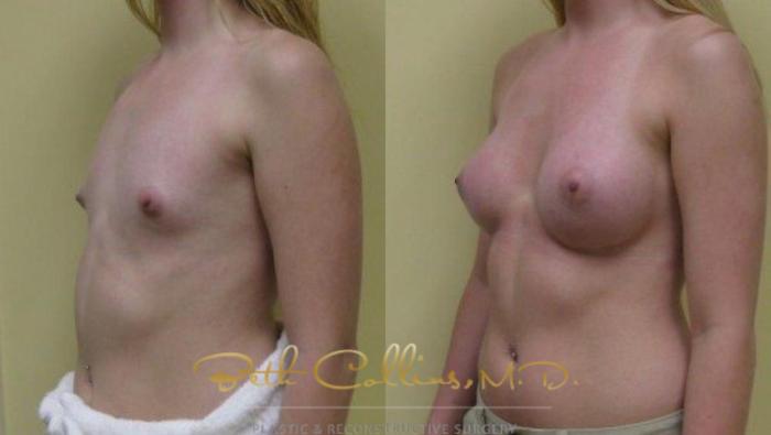 Before & After Breast Augmentation Case 31 View #5 View in Guilford, CT
