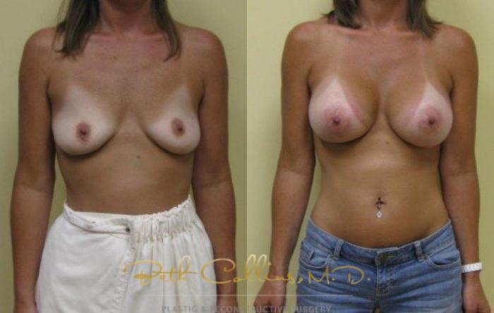 Before & After Breast Augmentation Case 32 View #1 View in Guilford, CT
