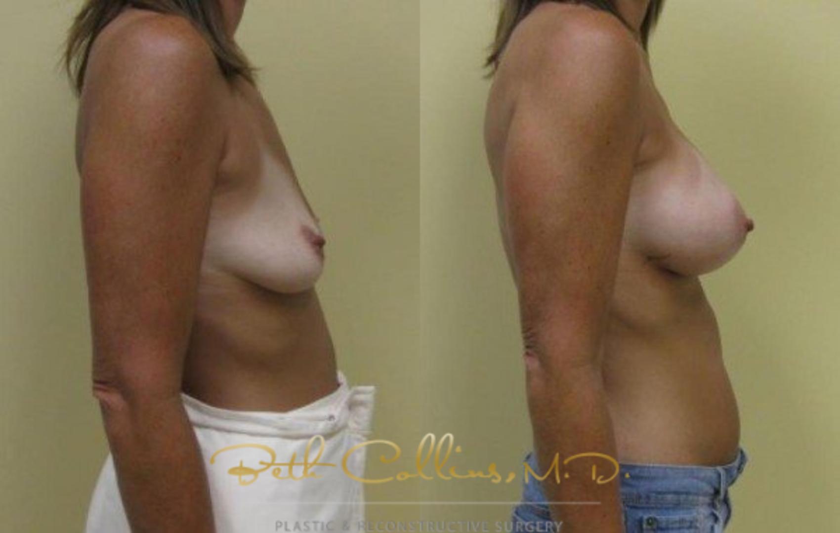 Before & After Breast Augmentation Case 32 View #2 View in Guilford, CT