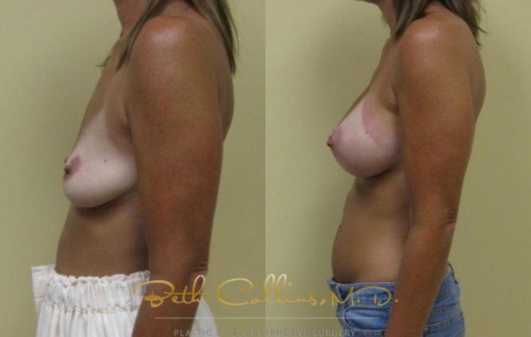 Before & After Breast Augmentation Case 32 View #5 View in Guilford, CT