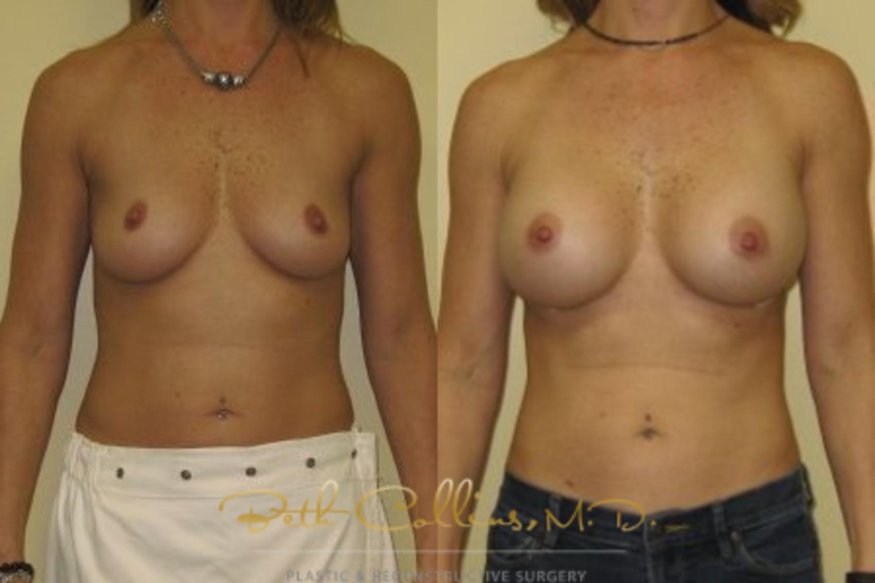 Before & After Breast Augmentation Case 33 View #1 View in Guilford, CT