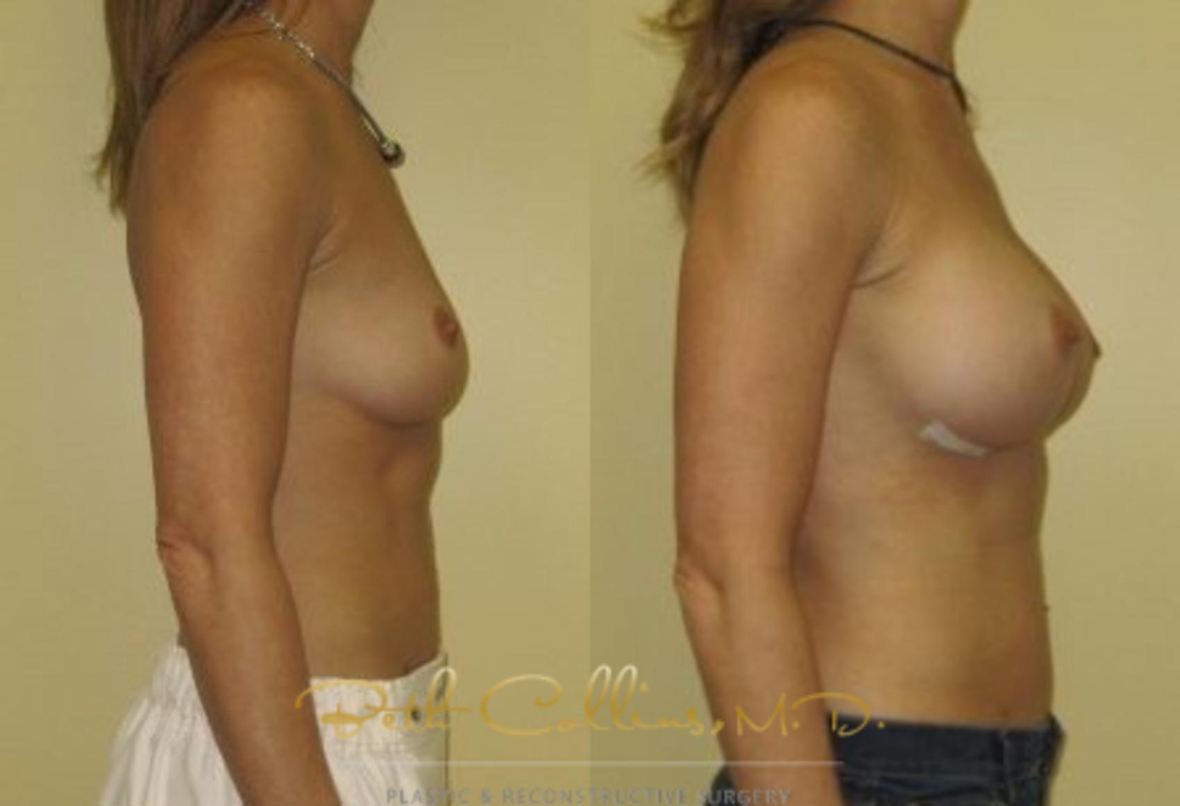 Before & After Breast Augmentation Case 33 View #2 View in Guilford, CT