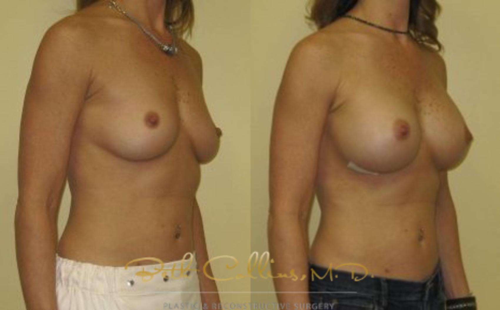 Before & After Breast Augmentation Case 33 View #3 View in Guilford, CT