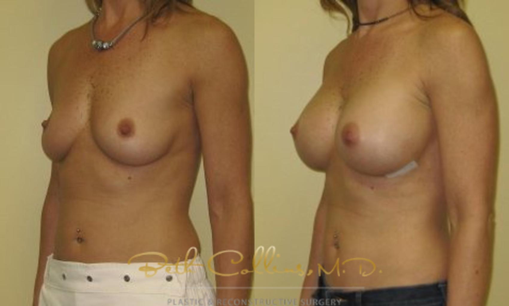 Before & After Breast Augmentation Case 33 View #4 View in Guilford, CT