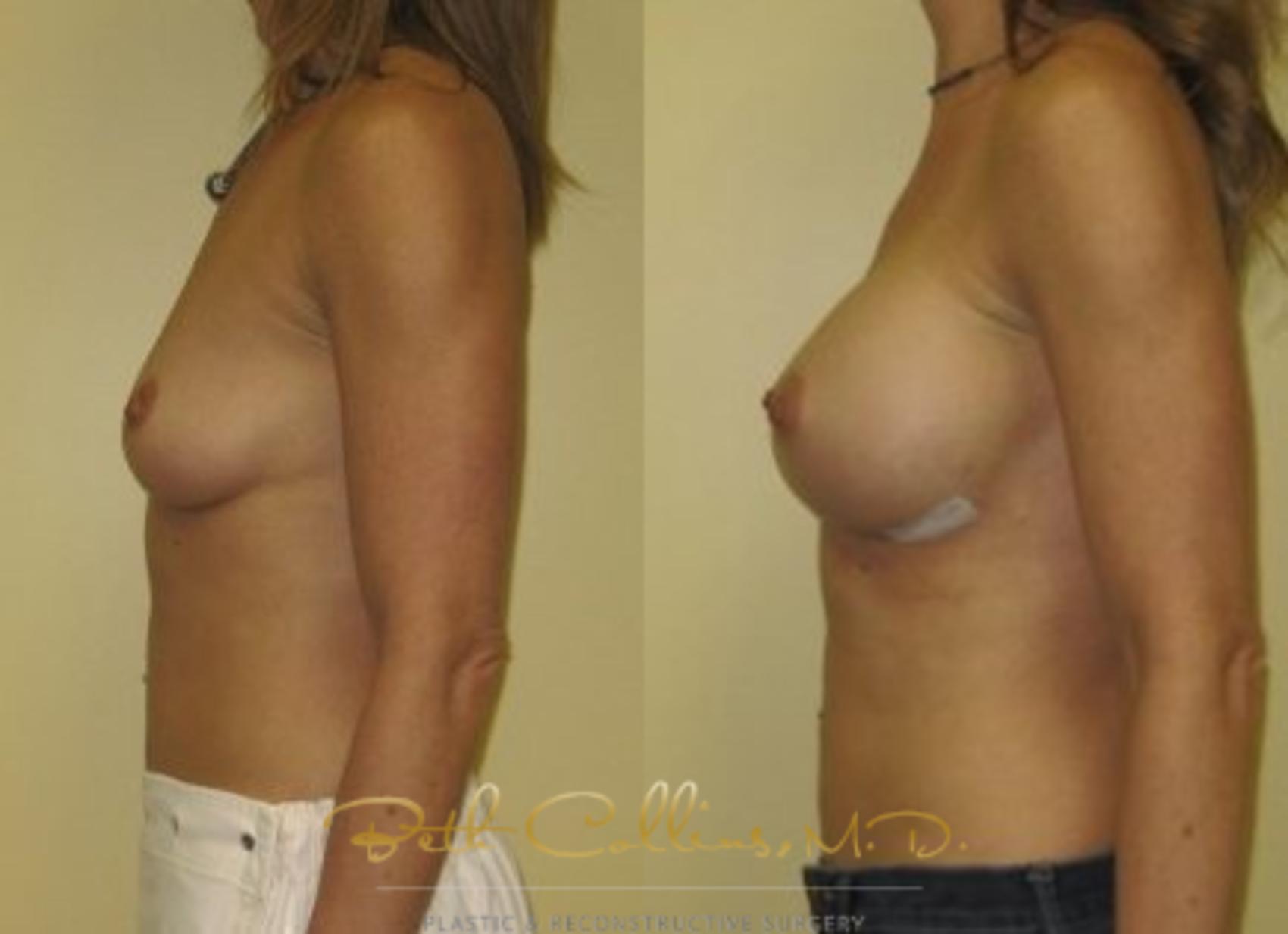 Before & After Breast Augmentation Case 33 View #5 View in Guilford, CT