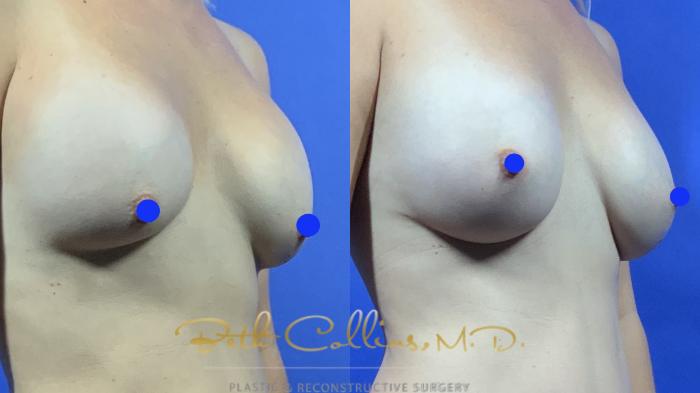 Breast augmentation correction