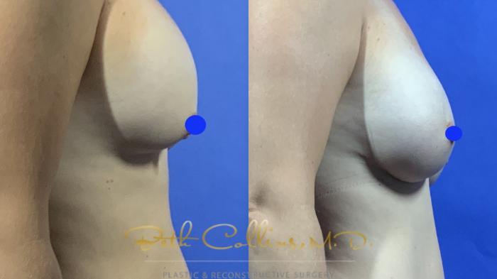 Before & After Breast Implant Exchange Case 157 Right Side View in Guilford, CT