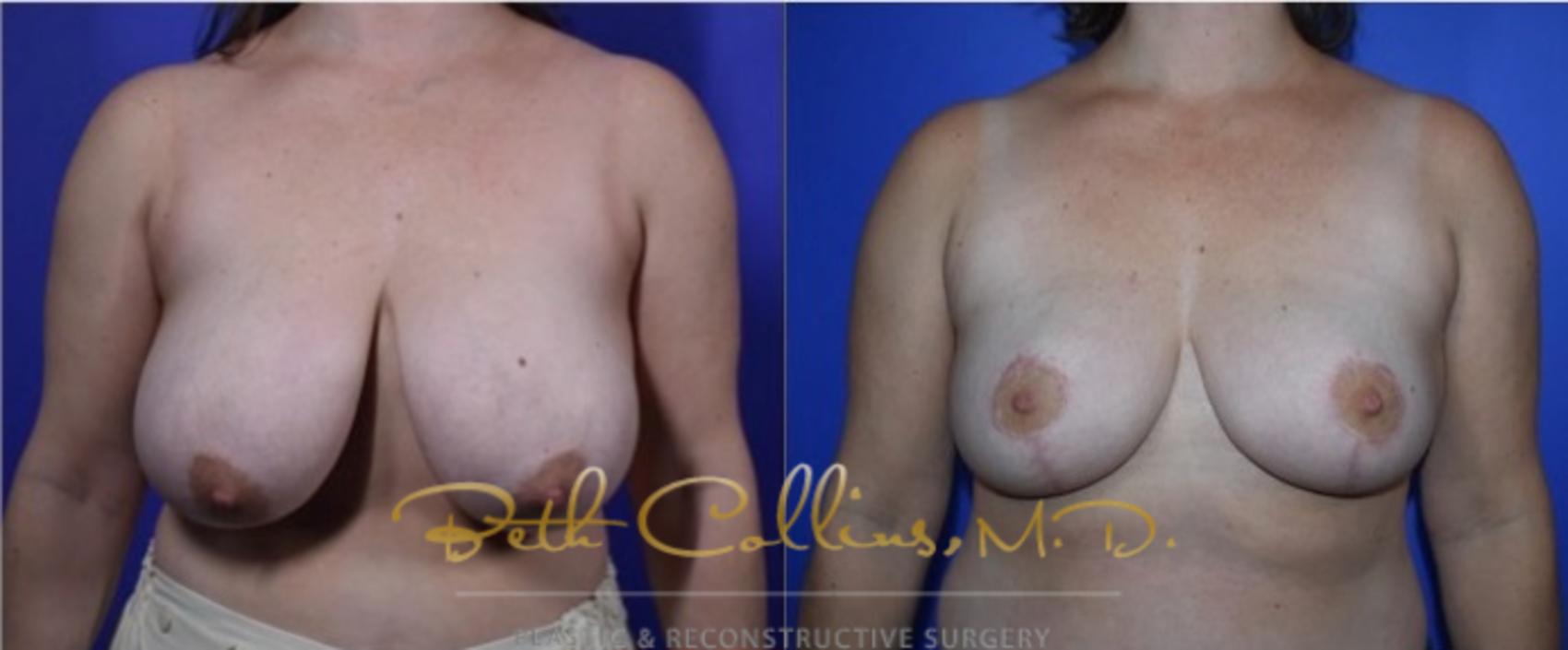 Before & After Breast Lift Case 121 View #1 View in Guilford, CT