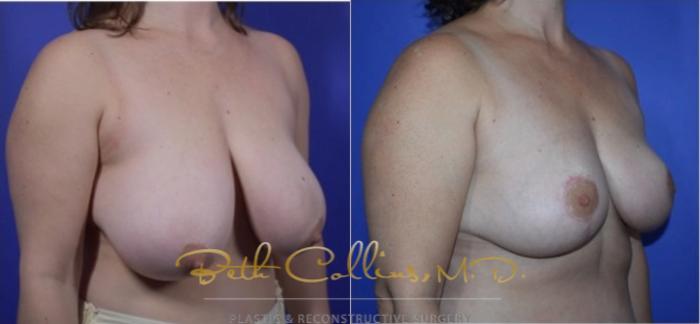 Before & After Breast Lift Case 121 View #2 View in Guilford, CT
