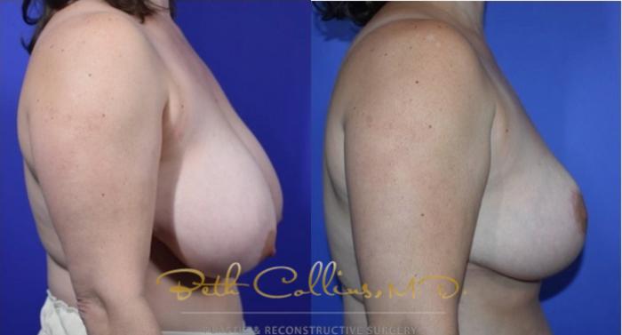 Before & After Breast Lift Case 121 View #3 View in Guilford, CT
